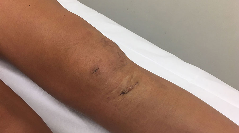 Photograph of knee documenting typical apperance  of wound at 10 days after surgery
